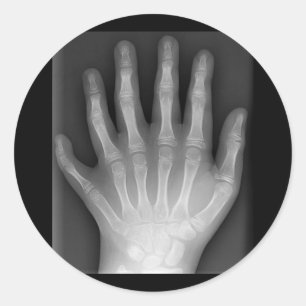 Sticker Rond Polydactylo, Six Doigts, X-Ray, rareté !
