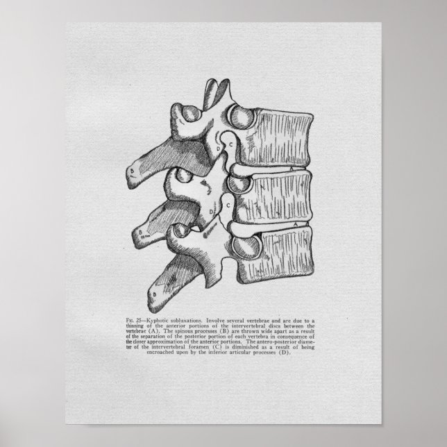 Subluxe chiropratique Impression Vintage (Devant)