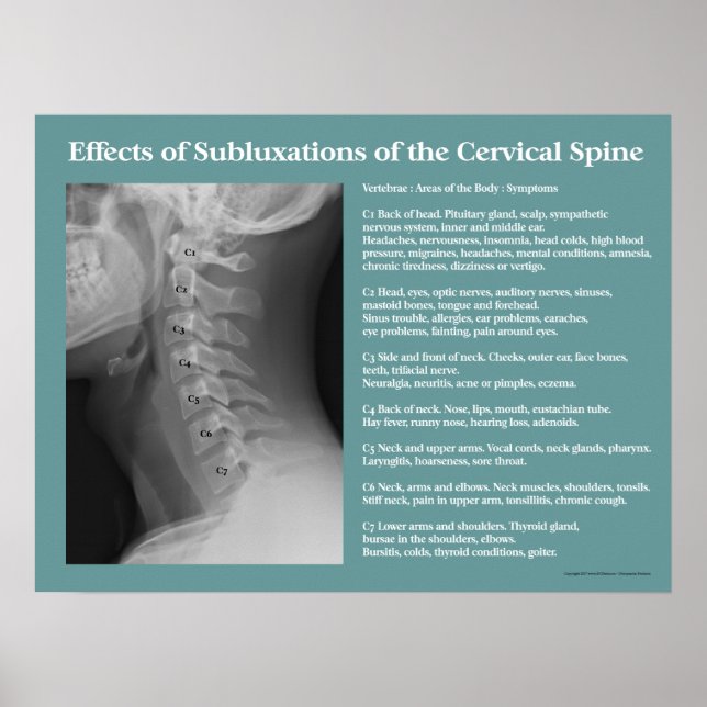 Subluxement Effets Spine Poster Chiropratique (Devant)