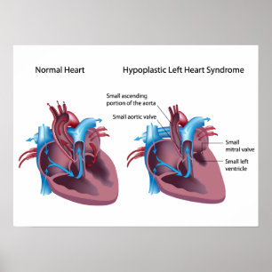 Syndrome Hypoplastique du coeur gauche Poster