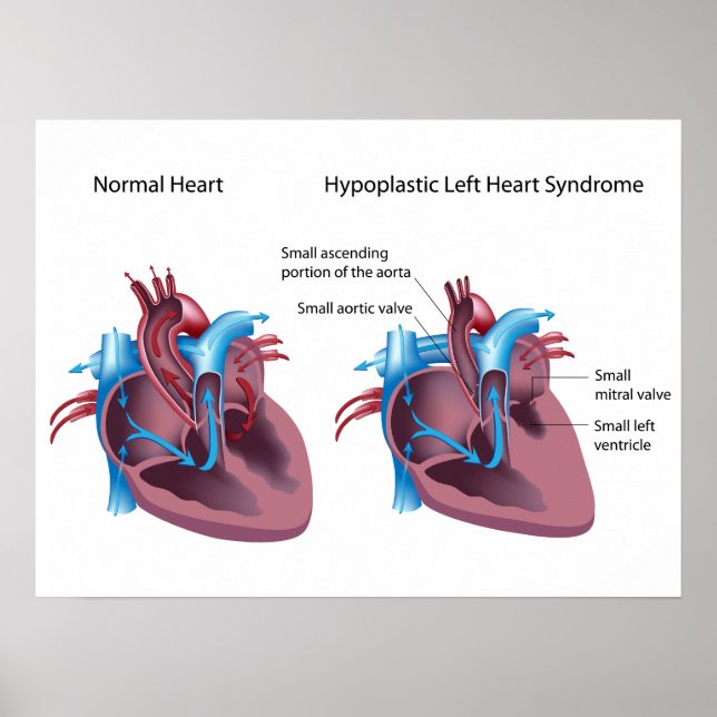 Syndrome Hypoplastique du coeur gauche Poster (Devant)