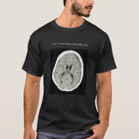 CT Scan_ CTFOD_Voici à quoi ressemble la dépressio