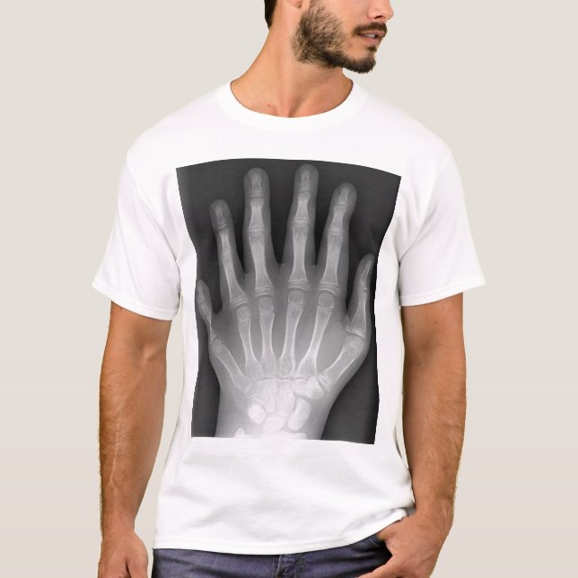 T-shirt Polydactyly, six mains digitées, rayon X, rareté ! (Devant)