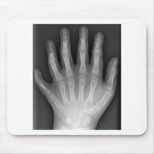 Tapis De Souris Polydactyly, six mains digitées, rayon X, rareté