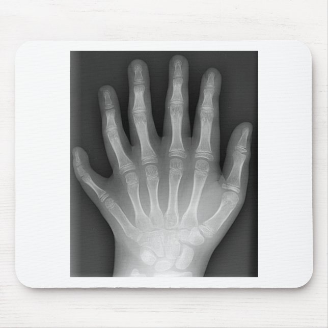 Tapis De Souris Polydactyly, six mains digitées, rayon X, rareté ! (Devant)