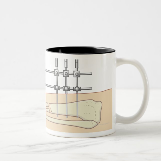Tasse 2 Couleurs Fixator externe (Droit)