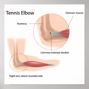 Tennis coude Sport blessure Poster