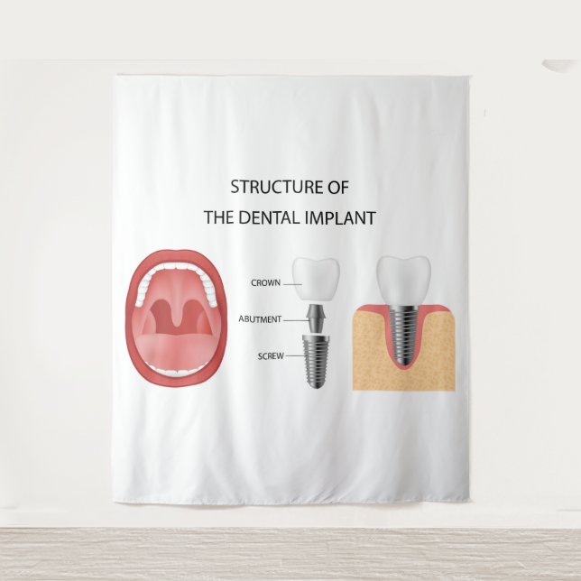 Tenture Structure de l'implant dentaire (Devant)