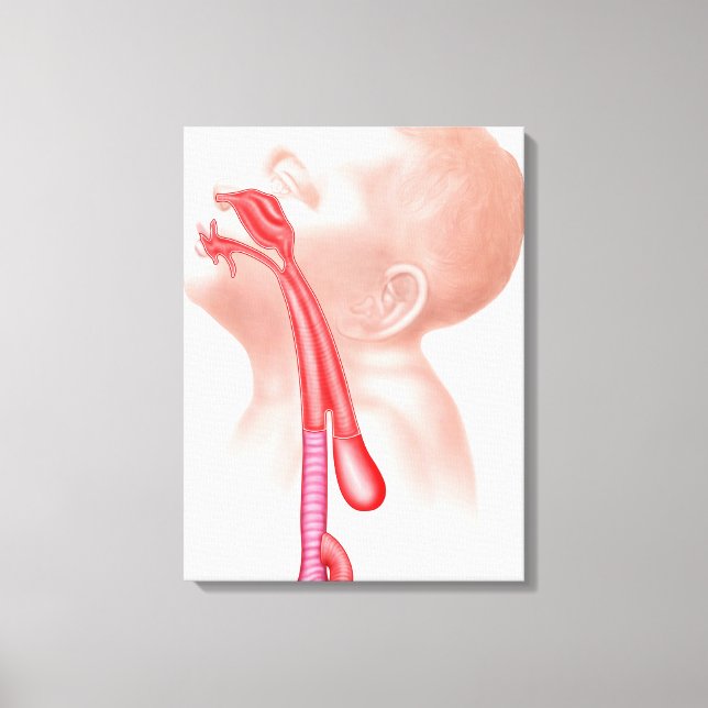 Toile Anatomie D'Une Fistule Trachéesophagienne (Recto)