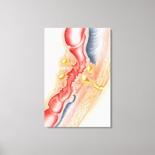 Toile Développement de fistule