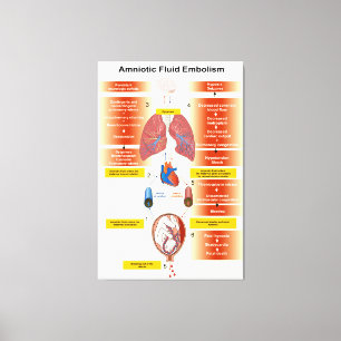 Toile Diagramme d'un embolisme amniotique de fluides AFE