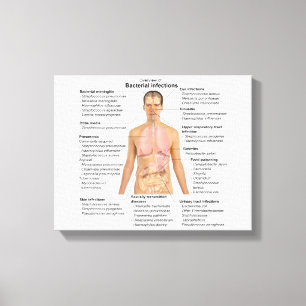 Toile Graphique des infections bactériennes chez l'Homme