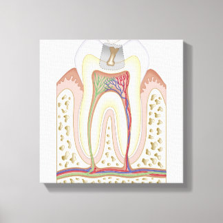 Toile Illustration de la carie dentaire