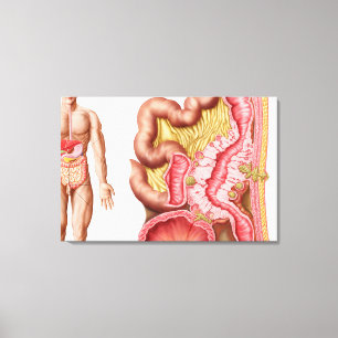 Toile Illustration De La Diverticulose Dans Le Colon