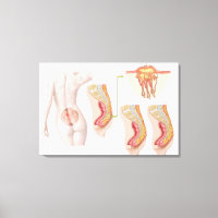 Illustration Médicale D'Un Cyst Pilonidal