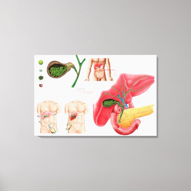 Toile Illustration montrant la cholécystectomie (Recto)