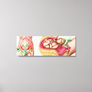 Toile Illustration Montrant La Livraison Cesarienne Du F