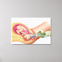 Illustration Montrant La Livraison Du Foetus 1