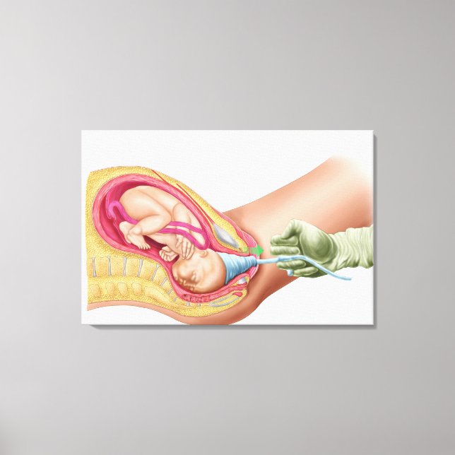 Toile Illustration Montrant La Livraison Du Foetus 1 (Recto)