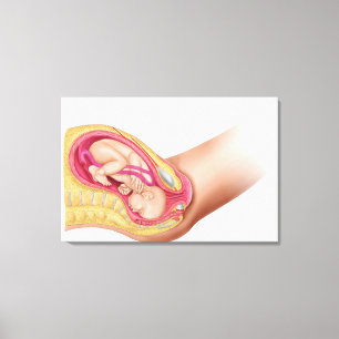 Toile Illustration Montrant La Livraison Du Foetus 2