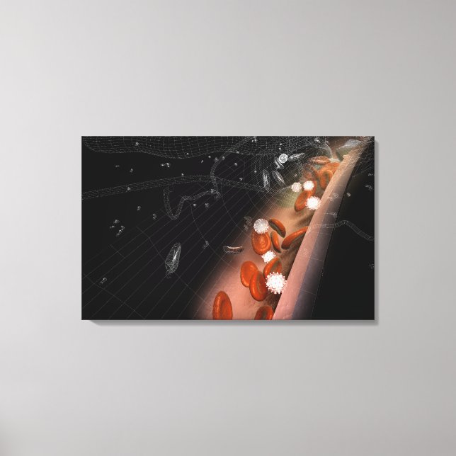 Toile Plaque dans les artères (Recto)