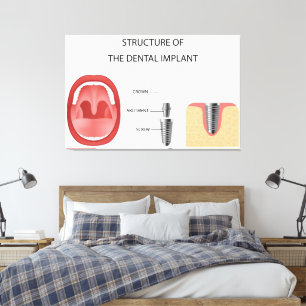 Toile Structure de l'implant dentaire