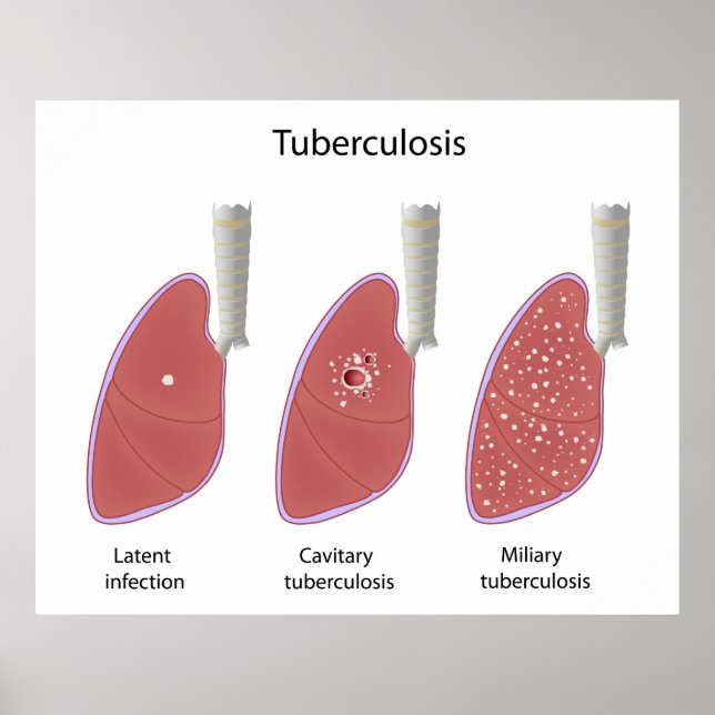 Tuberculosis types Poster (Devant)