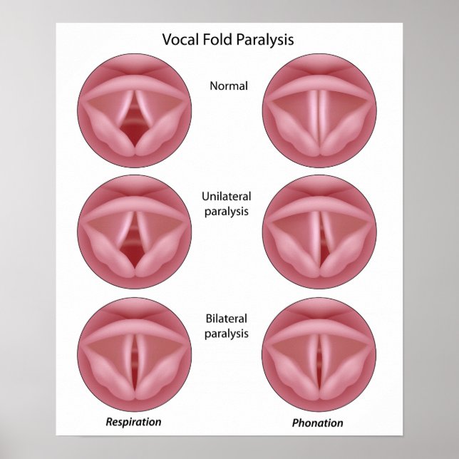 Vocal cord paralysis Poster (Devant)