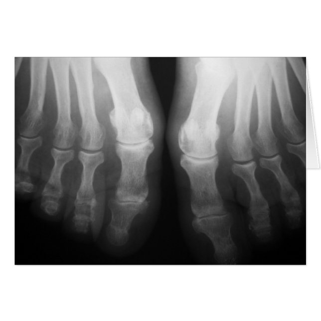 X-Ray Pieds humains Skeleton Bones noir et blanc (Devant Horizontal)